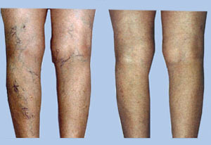 Sclerotherapy Before and After
