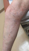 diehl leg after phlebectomy