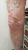 Diehl Leg Before Phlebectomy