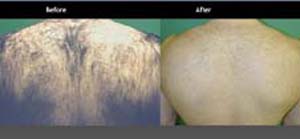 hair removal treatment, back