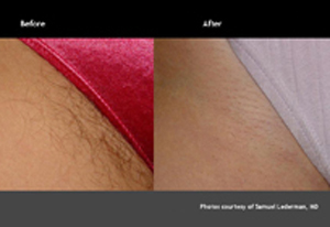 laser hair removal bikini line