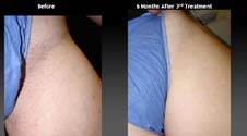 hair removal treatment, bikini