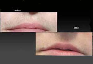 hair removal treatment, upper lip