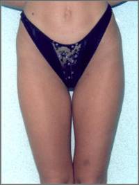 Thighs (1) After