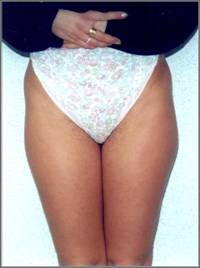Thighs (1) Before
