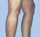 spider vein removal, after