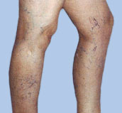 Sclerotherapy for spider vein treatment, before