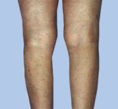 Spider Vein Removal, After