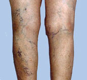 Sclerotherapy "Before" No. 1