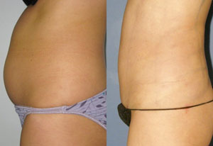 SmartLipo Female Abdomen