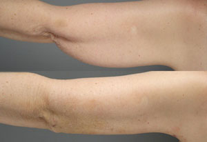Smart Lipo Arms 2