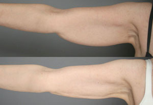SmartLipo Arms 3