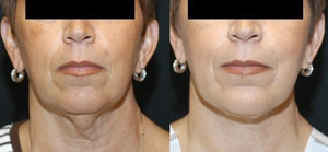 SmartLipo Skin Tightening