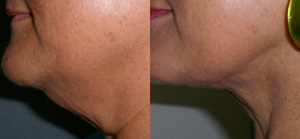 SmartLipo Skin Tightening, Chin