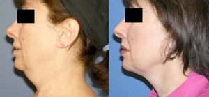 SmartLipo Skin tightening, Neck