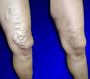 Varicose Vein Treatment