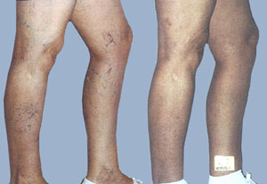 Spider Vein Treatment Before and After 2