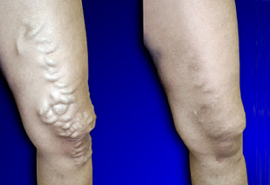 Varicose Vein Treatment Before and After