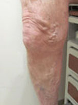 Varicose Vein Treatment: Before
