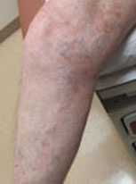 Varicose Vein Treatment: After