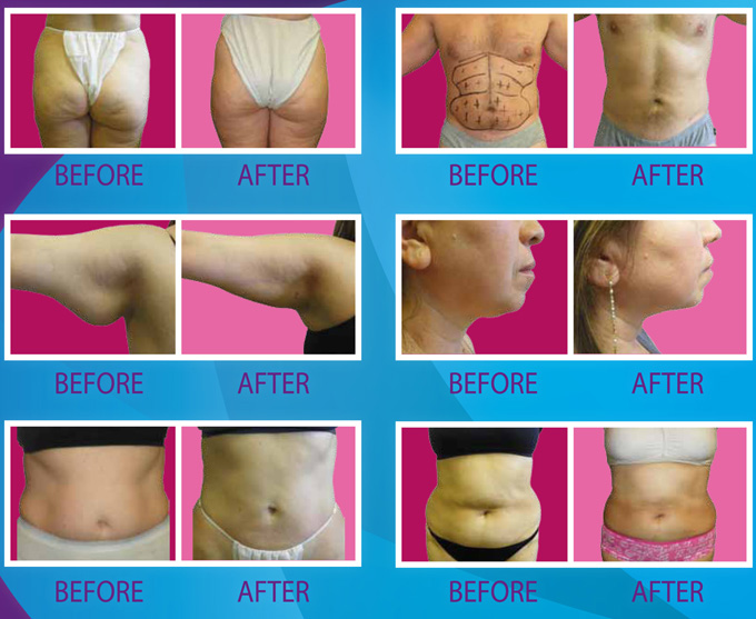 Recent Before and After photos from Venolase