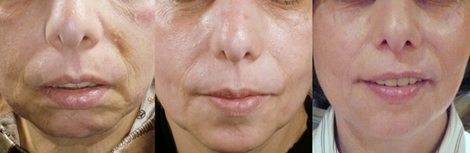 Liquid Facelift