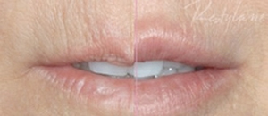 Restylane, expample 1