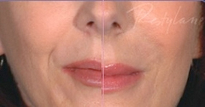 Restylane, example 2