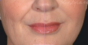 Restylane, example 3