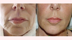 Sculptra, second example