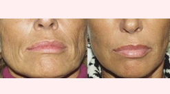 Sculptra, third example